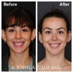 Otoplasty - Before and After