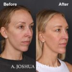 Chin implant - before and after