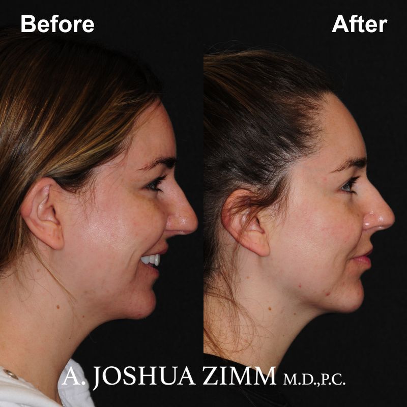 Chin implant - before and after