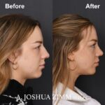 Revision Rhinoplasty - Before and After