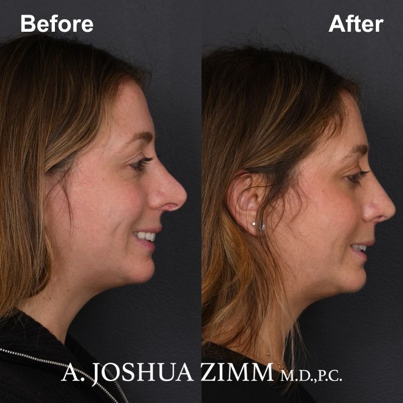 Revision Rhinoplasty - Before and After