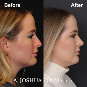 Revision Rhinoplasty - Before and After