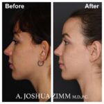 Otoplasty - Before and After