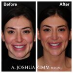 Chin implant - before and after