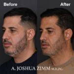 Chin implant - before and after