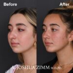 Chin implant - before and after