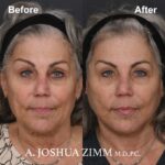 Facelift - before and after