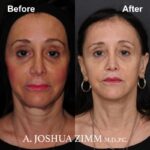 Facelift - before and after