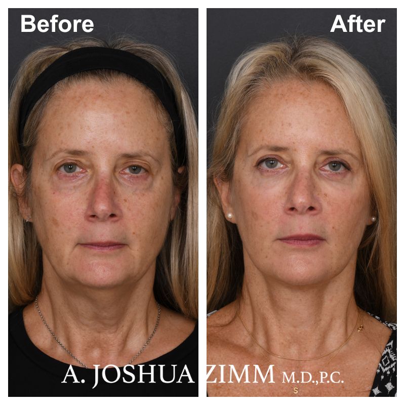 Facelift - before and after