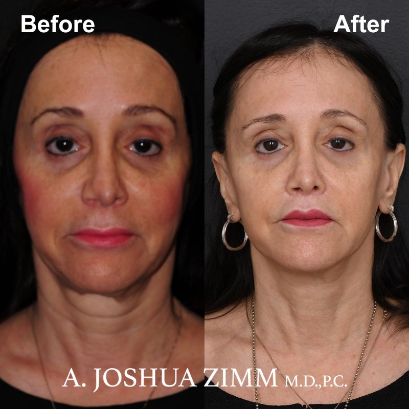 Facelift - before and after