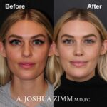 Rhinoplasty - before and after