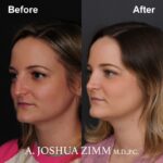 Rhinoplasty - before and after