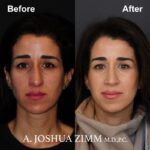 Rhinoplasty - before and after