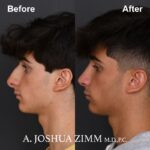 Rhinoplasty - before and after