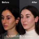 Rhinoplasty - before and after