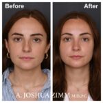 Rhinoplasty - before and after