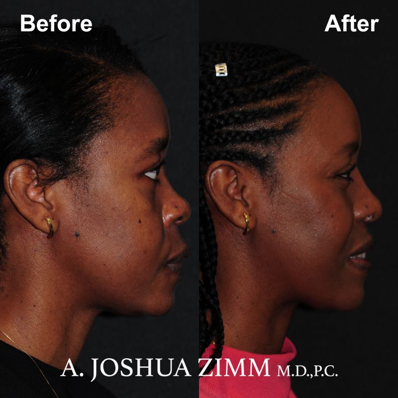 Rhinoplasty - before and after