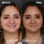 Rhinoplasty - before and after