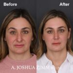 Rhinoplasty - before and after