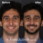 Rhinoplasty - before and after