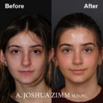 Rhinoplasty - before and after