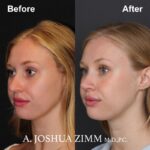 Rhinoplasty - before and after