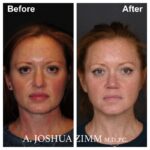 Rhinoplasty - before and after