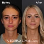 Rhinoplasty - before and after