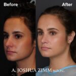 Rhinoplasty - before and after