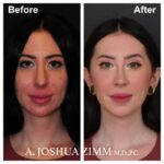 Rhinoplasty - before and after