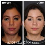 Rhinoplasty - before and after