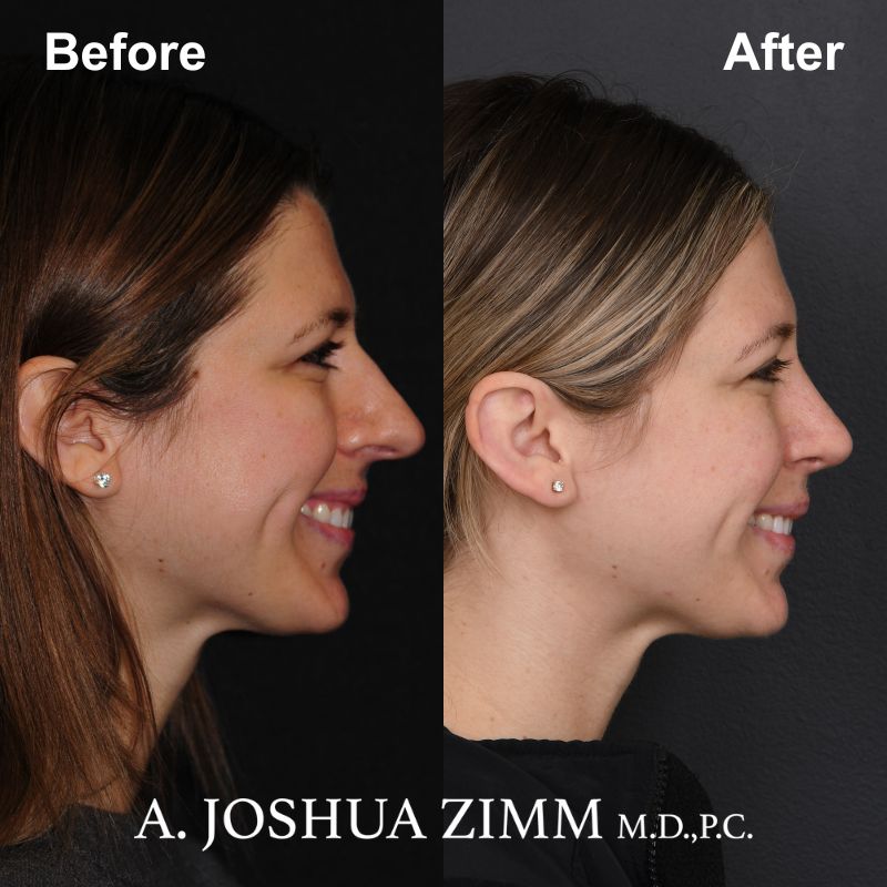 Rhinoplasty - before and after