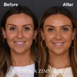 Rhinoplasty - before and after