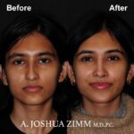 Rhinoplasty - before and after