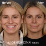 Rhinoplasty - before and after