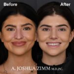 Rhinoplasty - before and after