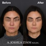 Rhinoplasty - before and after