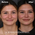 Rhinoplasty - before and after