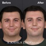 Rhinoplasty - before and after