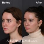 Rhinoplasty - before and after