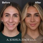 Rhinoplasty - before and after