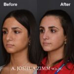 Rhinoplasty - before and after