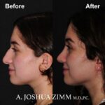 Rhinoplasty - before and after