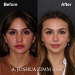 Rhinoplasty - before and after