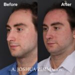 Rhinoplasty - before and after