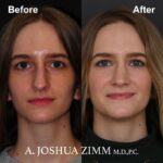 Rhinoplasty - before and after