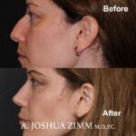 Rhinoplasty - before and after