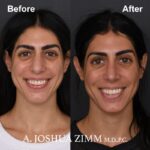 Rhinoplasty - before and after