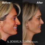 Rhinoplasty - before and after