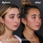 Rhinoplasty - before and after